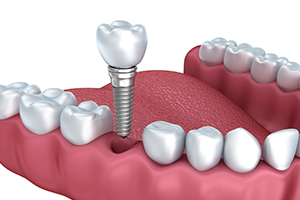 Animation of dental implant placement
