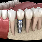 Animation of implant supported dental crown