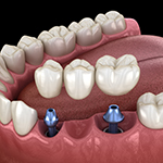 Animation of implant supported fixed bridge