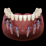 Animation of implant supported denture