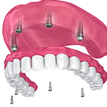 Animation of All-on-4 denture
