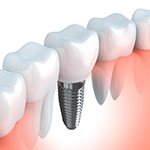 Animation of mini dental implant supported crown