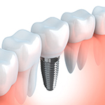 Animation of mini dental implant supported crown
