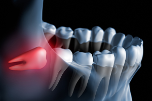 Animation of impacted wisdom tooth