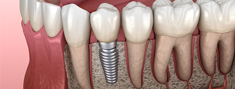 Animation of implant supported replacement tooth