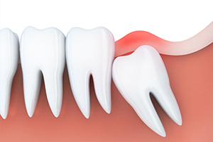 Animation of impacted wisdom tooth