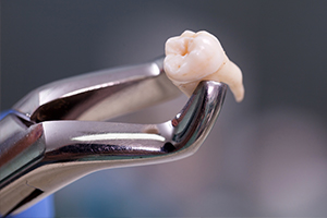 Metal clasp holding an extracted tooth